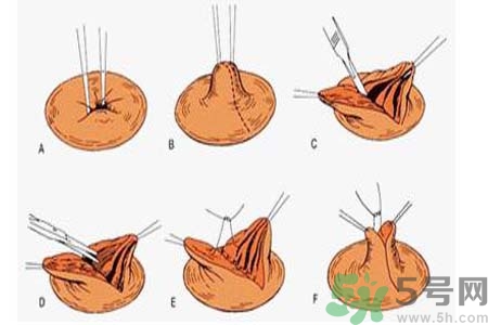 乳頭內(nèi)陷可以拔罐嗎？乳頭內(nèi)陷需要手術(shù)治療嗎？