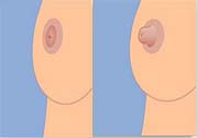 乳頭內(nèi)陷可以用吸奶器嗎？乳頭內(nèi)陷能不能用吸奶器？