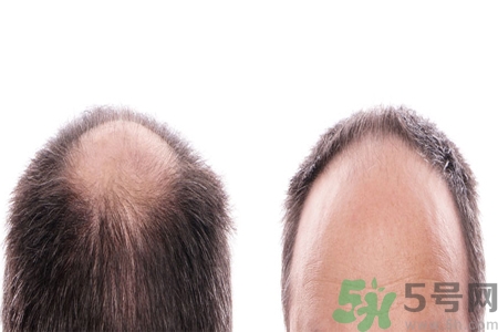 頭發(fā)稀少的原因是什么？如何預(yù)防禿頂?shù)陌l(fā)生？