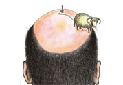 禿頂會遺傳嗎？治療禿頂?shù)姆椒ㄊ鞘裁矗?><p><strong>禿頂會遺傳嗎？治療禿頂?shù)姆椒ㄊ鞘裁矗?/strong></p></a></li> </ul>
</div>
<div   id=