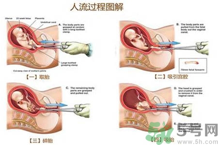 人工流產(chǎn)后多久可以再次懷孕？流產(chǎn)后需要注意什么？