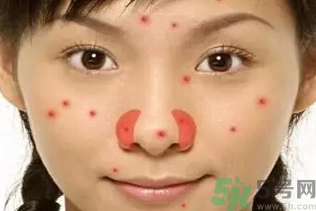 鼻翼長痘痘怎么回事？鼻翼長痘痘的原因是什么？