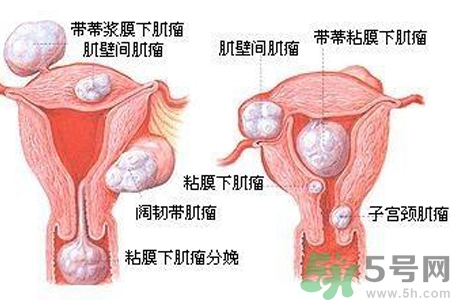 ?子宮移位怎么治療？子宮移位能懷孕嗎？