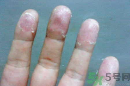 ?手掌脫皮的危害有哪些？如何預(yù)防手掌脫皮？