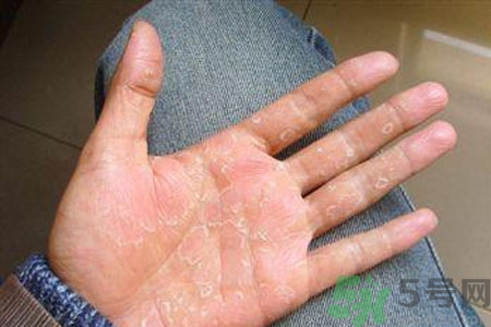 ?手掌脫皮的危害有哪些？如何預(yù)防手掌脫皮？