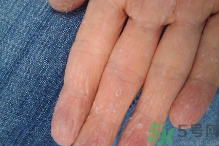 ?手掌脫皮的危害有哪些？如何預(yù)防手掌脫皮？