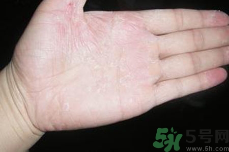 手脫皮是什么原因？手脫皮的治療方法是什么？
