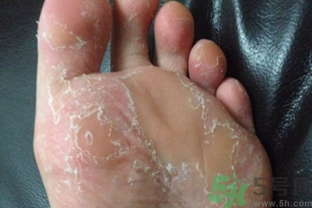 腳脫皮是怎么回事？腳脫皮怎么辦？