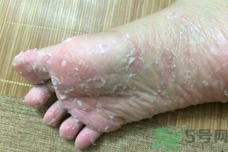 腳脫皮的治療方法有哪些？如何預防腳脫皮？
