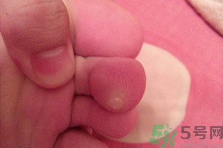 雞眼如何去除？腳上長了雞眼怎么治療？