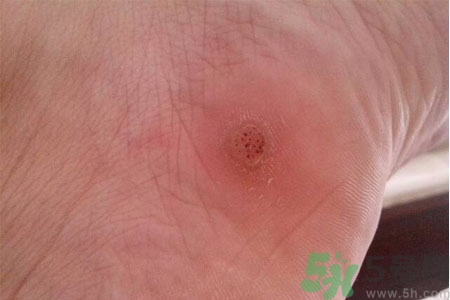 腳上長雞眼是怎么回事？腳上長雞眼是怎么辦？
