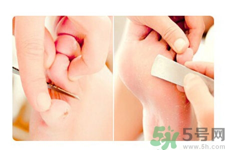 雞眼怎么能徹底根治？如何預(yù)防腳上長雞眼？