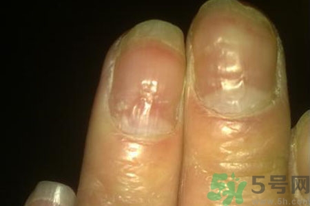 孩子手指甲凹凸不平是什么原因？手指甲凹凸不平的原因是什么？