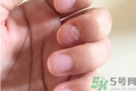 孩子手指甲凹凸不平是什么原因？手指甲凹凸不平的原因是什么？