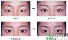 提眉術(shù)后多久可以恢復？提眉術(shù)后全過程照片