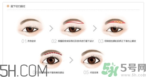 切眉手術(shù)后老得快嗎？切眉能保持多久？