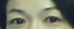 提眉術(shù)后多久可以恢復？提眉術(shù)后全過程照片