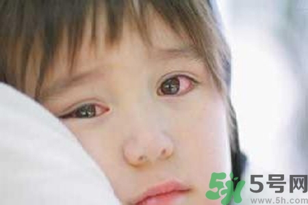 流行性腮腺炎的表現(xiàn)有哪些？?流行性腮腺炎飲食怎么調(diào)理？