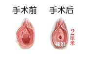 處女膜修補術(shù)效果怎么樣？處女膜修復(fù)手術(shù)有風(fēng)險嗎？