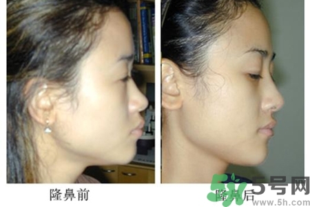 玻尿酸隆鼻的危害有哪些？玻尿酸隆鼻的副作用是什么？