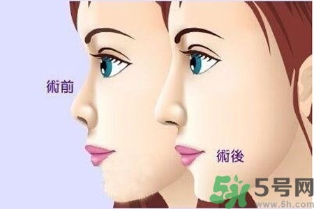 玻尿酸隆鼻的缺點是什么？玻尿酸隆鼻的優(yōu)點有哪些？