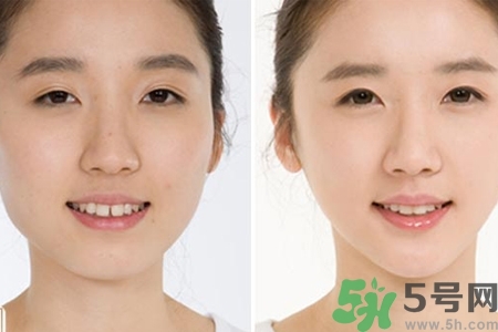 玻尿酸隆鼻的缺點是什么？玻尿酸隆鼻的優(yōu)點有哪些？