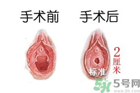 什么人不能做處女膜修補術(shù)？處女膜修補術(shù)會留疤嗎？