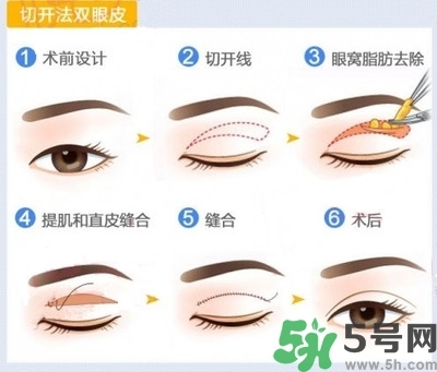 雙眼皮手術(shù)哪種最好？割雙眼皮后注意些什么？