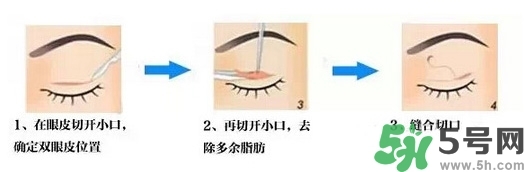 雙眼皮手術(shù)哪種最好？割雙眼皮后注意些什么？