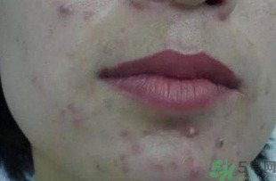 什么樣的痘痘能擠？哪些痘痘不能擠？