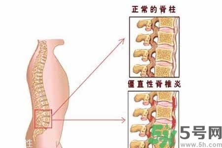 僵直性脊椎炎的癥狀有哪些？怎樣預(yù)防僵直性脊椎炎？