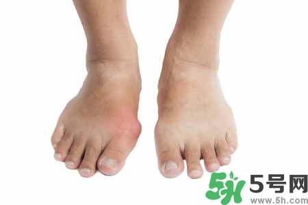 引發(fā)痛風(fēng)的原因是什么？痛風(fēng)病人飲食需注意什么好？