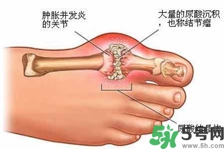 引發(fā)痛風(fēng)的原因是什么？痛風(fēng)病人飲食需注意什么好？