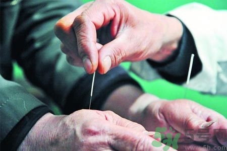 針灸一次要扎多長時(shí)間？針灸可以幾天做一次？