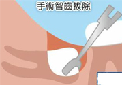 智齒拔完后有個洞怎么辦？拔智齒后有個洞多久能長好？