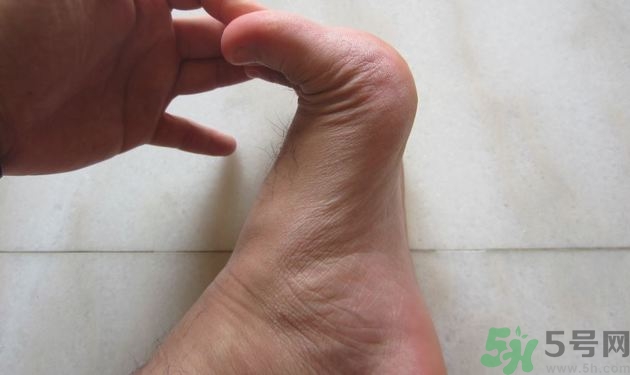 腳拇指外翻遺傳嗎？腳拇指外翻怎么矯正？