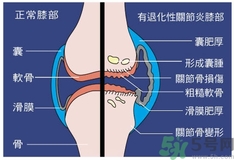 骨關節(jié)炎能治好嗎？骨關節(jié)炎平時注意事項
