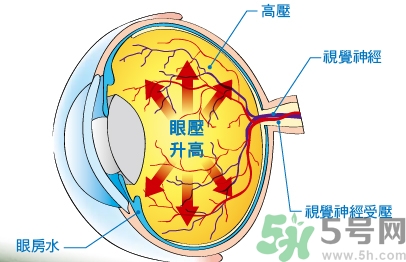 青光眼可以治愈嗎？青光眼怎樣治療？
