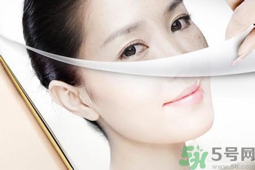 曬斑可以自己消退嗎？曬斑可以用激光去除嗎？