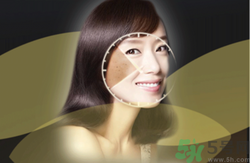 曬斑可以自己消退嗎？曬斑可以用激光去除嗎？