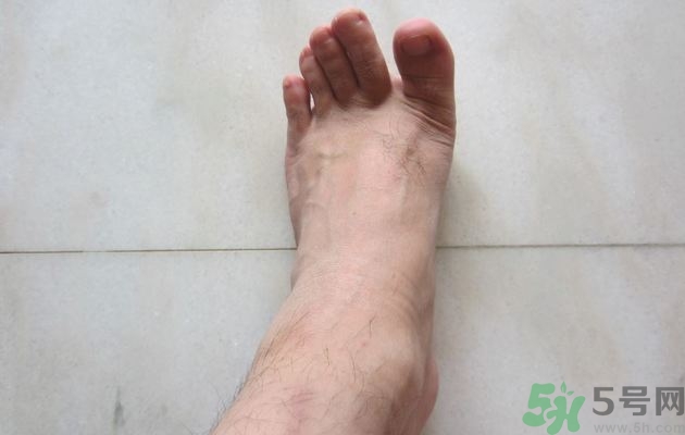 腳拇指外翻遺傳嗎？腳拇指外翻怎么矯正？