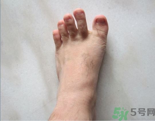 腳拇指外翻遺傳嗎？腳拇指外翻怎么矯正？