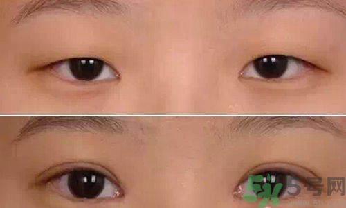 天生腫眼泡怎么消除？天生腫眼泡怎么辦？