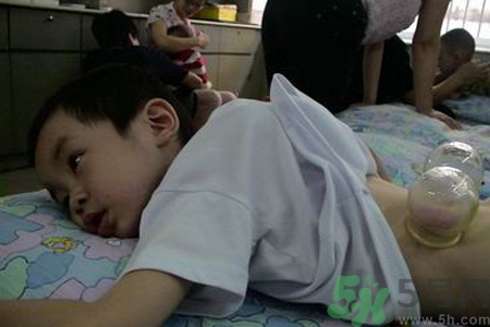 小孩可以拔罐嗎？寶寶能拔火罐嗎？