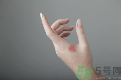 手被燙紅了怎么辦？手被燙了怎么止痛？