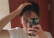 頭痛可以在額頭上拔火罐嗎？額頭上拔火罐有什么好處？