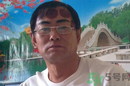 頭痛可以在額頭上拔火罐嗎？額頭上拔火罐有什么好處？