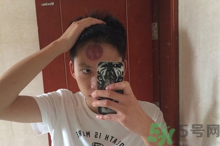 頭痛可以在額頭上拔火罐嗎？額頭上拔火罐有什么好處？