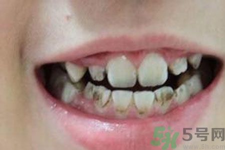 小孩牙齒發(fā)黑怎么回事？小孩牙齒發(fā)黑怎么辦？