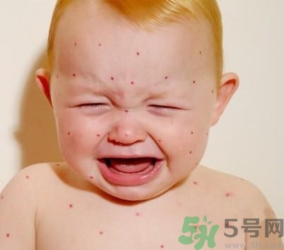新生兒濕疹怎么引起的？新生兒濕疹如何處理？